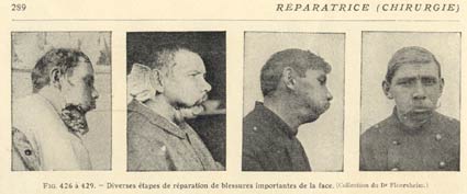 Les débuts de la chirurgie de guerre maxillo-faciale.